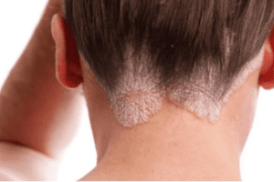 Dermatitis Seborreica: Aloe Vera y Aceite de Coco