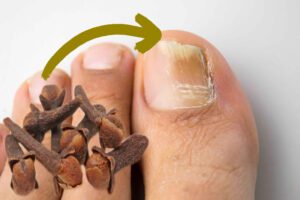 Elimina los Hongos de las Uñas
