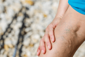 Cómo Eliminar las Varices Naturalmente: Remedios Caseros y Consejos Efectivos 🦵🌿